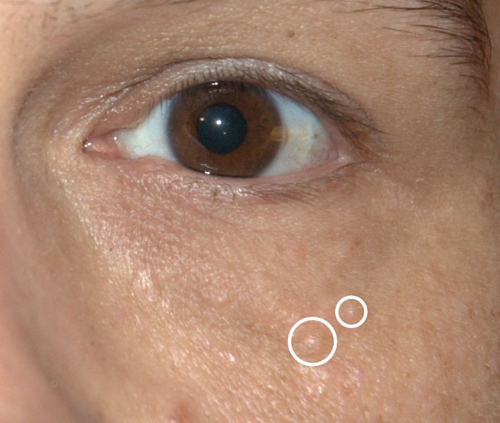 Image of syringoma, a benign skin condition characterized by small, firm bumps on the skin.